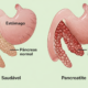 imagem comparativa do pancreas saudavel e do pancreas doente em cães.